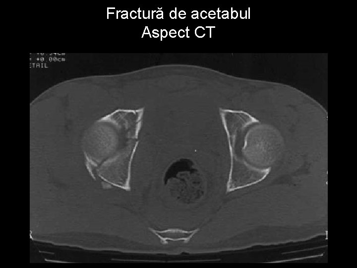 Fractură de acetabul Aspect CT 