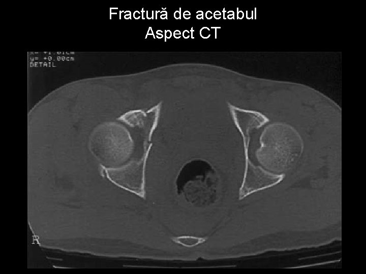 Fractură de acetabul Aspect CT 