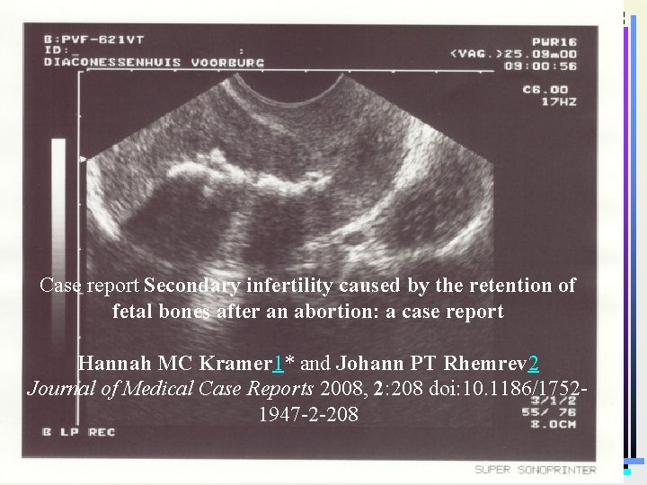 Case report Secondary infertility caused by the retention of fetal bones after an abortion: