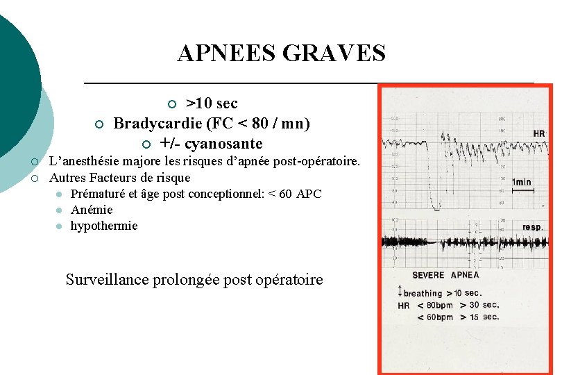 APNEES GRAVES >10 sec Bradycardie (FC < 80 / mn) ¡ +/- cyanosante ¡ APNEES GRAVES >10 sec Bradycardie (FC < 80 / mn) ¡ +/- cyanosante ¡