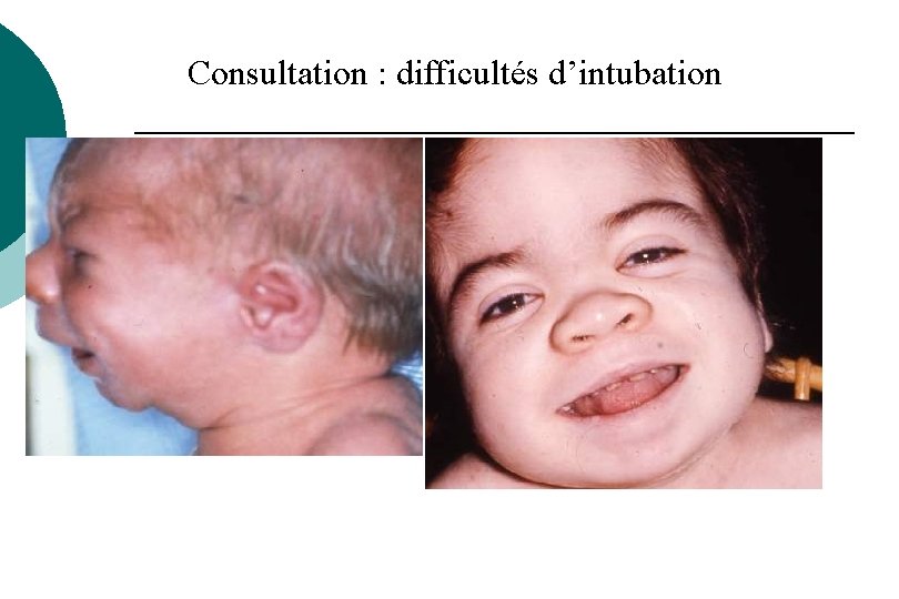 Consultation : difficultés d’intubation Consultation : difficultés d’intubation