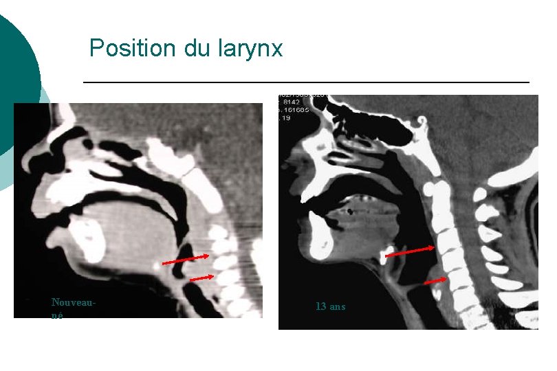 Position du larynx Nouveauné 13 ans Position du larynx Nouveauné 13 ans