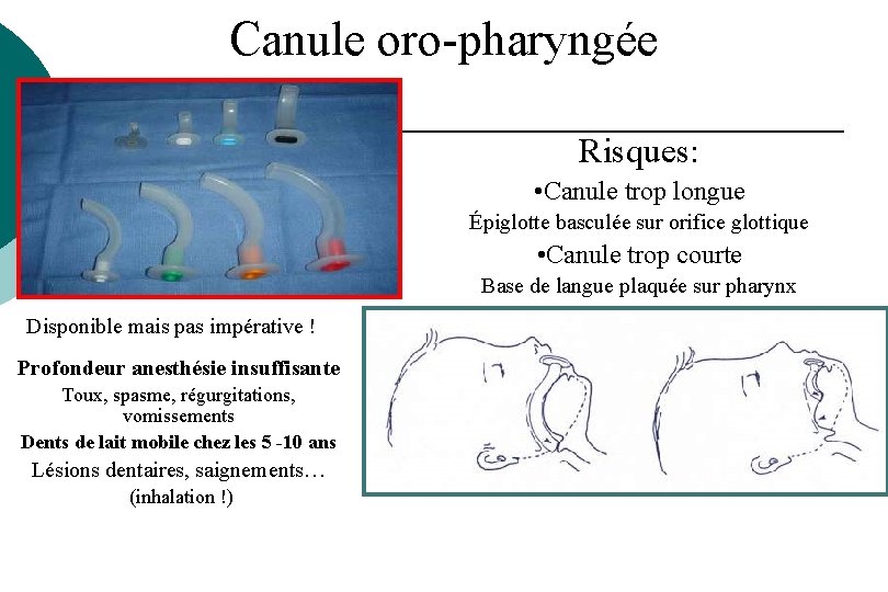 Canule oro-pharyngée Risques: • Canule trop longue Épiglotte basculée sur orifice glottique • Canule Canule oro-pharyngée Risques: • Canule trop longue Épiglotte basculée sur orifice glottique • Canule