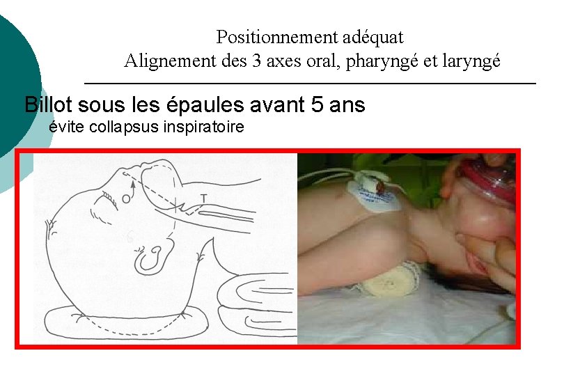 Positionnement adéquat Alignement des 3 axes oral, pharyngé et laryngé Billot sous les épaules Positionnement adéquat Alignement des 3 axes oral, pharyngé et laryngé Billot sous les épaules