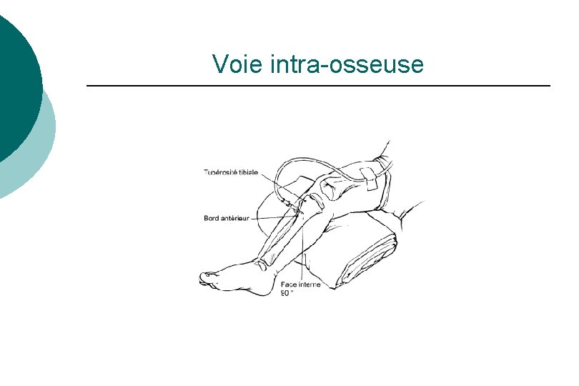 Voie intra-osseuse Voie intra-osseuse