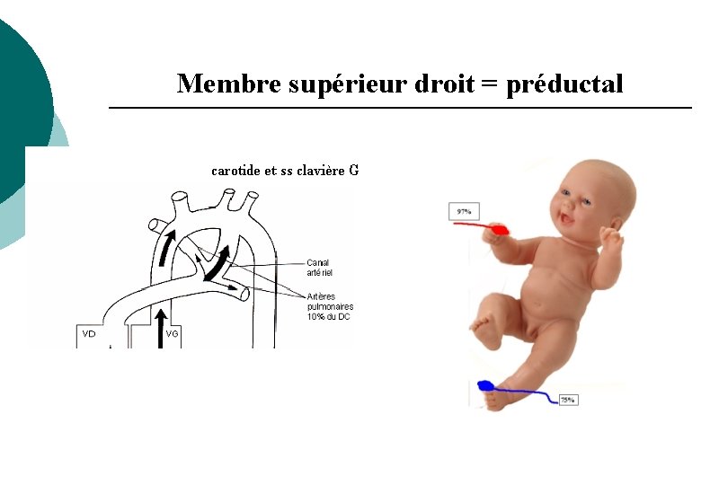 Membre supérieur droit = préductal Membre supérieur droit = préductal