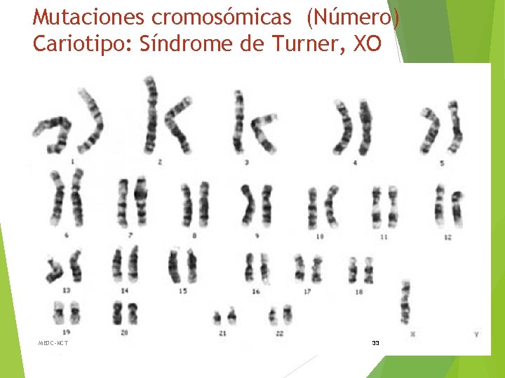 Mutaciones cromosómicas (Número) Cariotipo: Síndrome de Turner, XO MEDC-NCT 33 