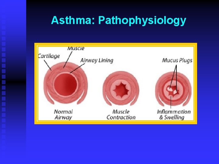 Asthma: Pathophysiology 