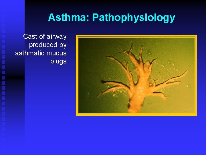 Asthma: Pathophysiology Cast of airway produced by asthmatic mucus plugs 