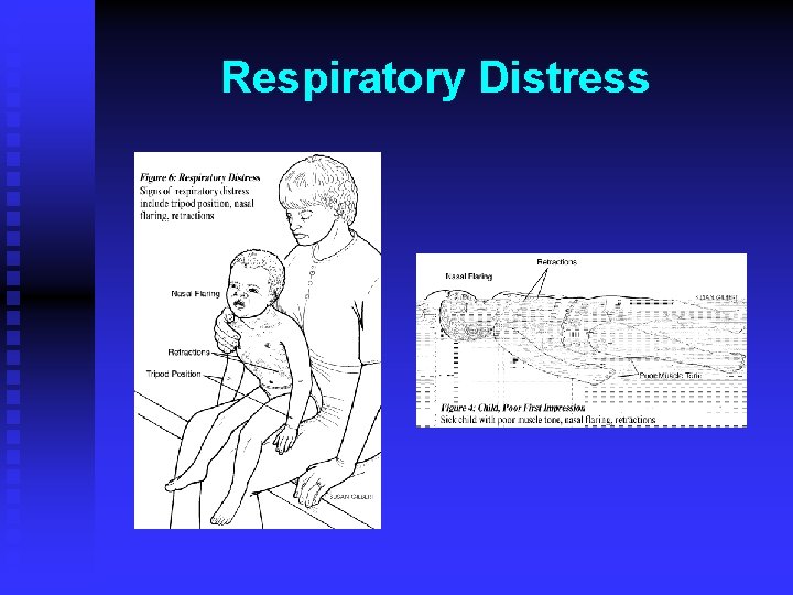 Respiratory Distress 