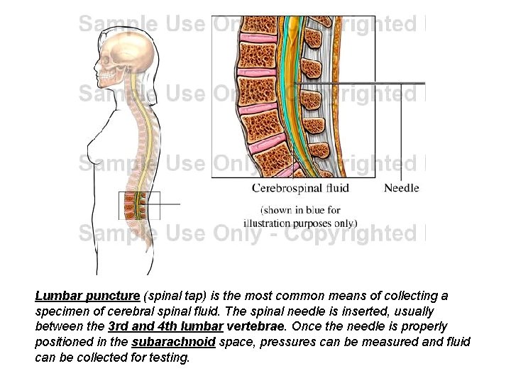 Lumbar puncture (spinal tap) is the most common means of collecting a specimen of