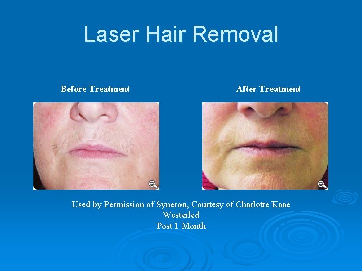 Laser Hair Removal Before Treatment After Treatment Used by Permission of Syneron, Courtesy of