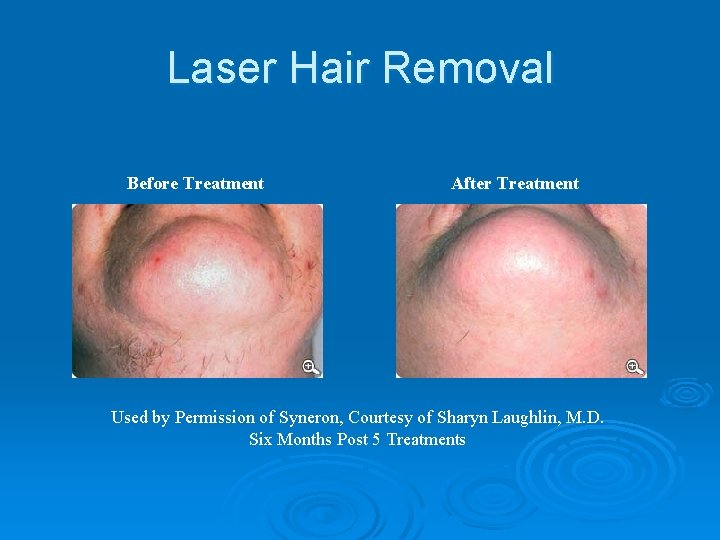 Laser Hair Removal Before Treatment After Treatment Used by Permission of Syneron, Courtesy of