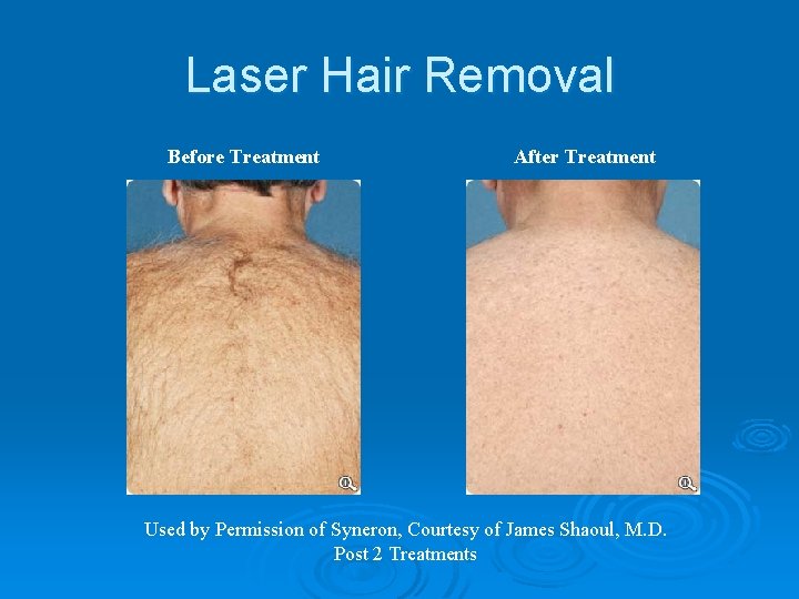 Laser Hair Removal Before Treatment After Treatment Used by Permission of Syneron, Courtesy of