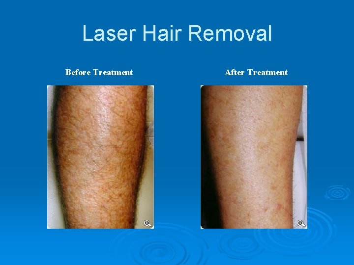 Laser Hair Removal Before Treatment After Treatment 