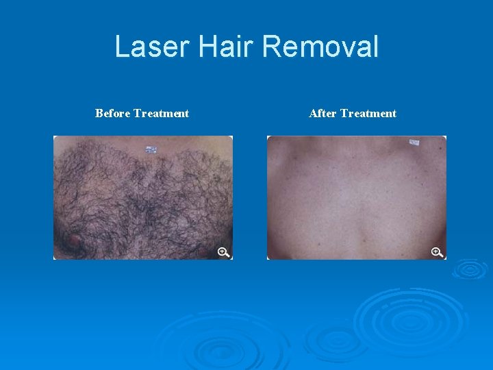 Laser Hair Removal Before Treatment After Treatment 