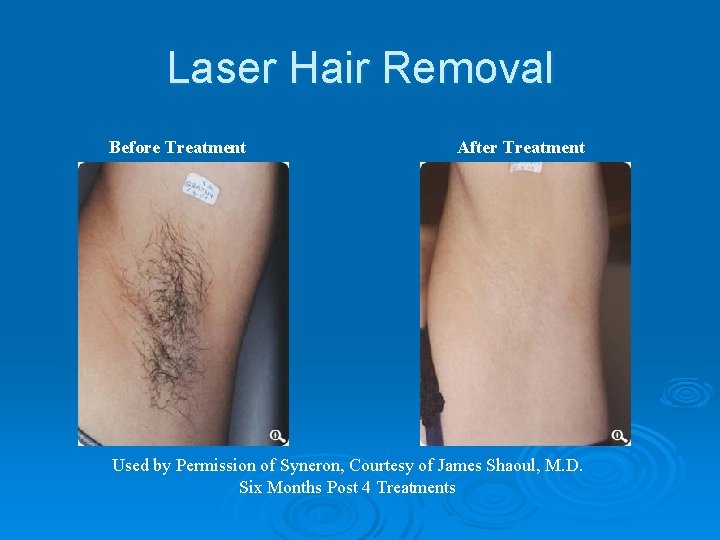 Laser Hair Removal Before Treatment After Treatment Used by Permission of Syneron, Courtesy of