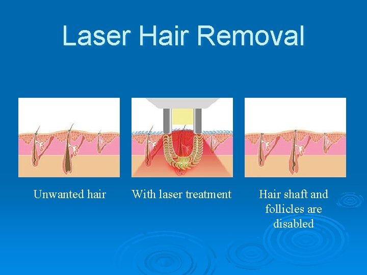 Laser Hair Removal Unwanted hair With laser treatment Hair shaft and follicles are disabled