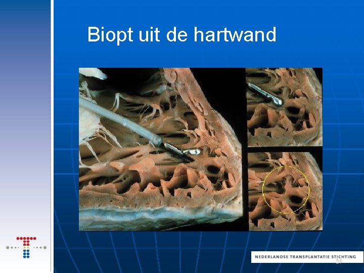 Biopt uit de hartwand 21 