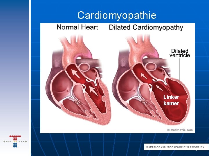 Cardiomyopathie Linker kamer 8 