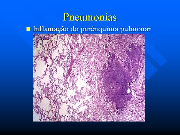 Pneumonias n Inflamação do parênquima pulmonar 