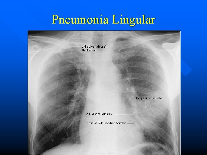Pneumonia Lingular 