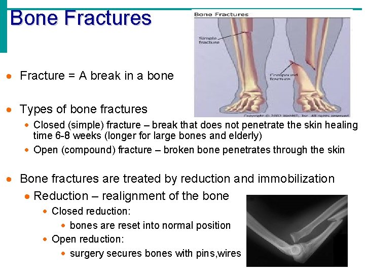 Bone Fractures · Fracture = A break in a bone · Types of bone Bone Fractures · Fracture = A break in a bone · Types of bone