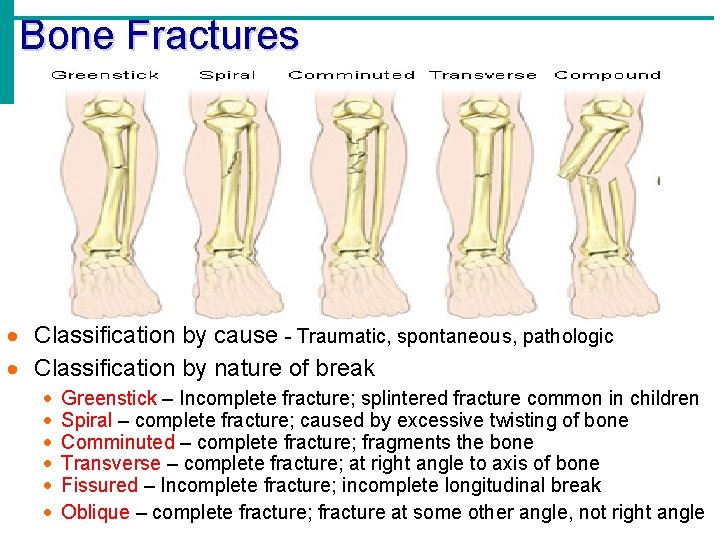 Bone Fractures · Classification by cause - Traumatic, spontaneous, pathologic · Classification by nature Bone Fractures · Classification by cause - Traumatic, spontaneous, pathologic · Classification by nature