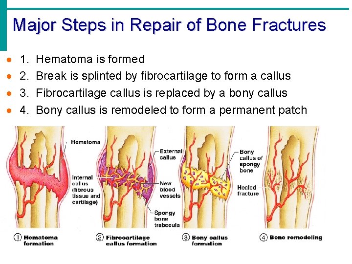 Major Steps in Repair of Bone Fractures · · 1. 2. 3. 4. Hematoma Major Steps in Repair of Bone Fractures · · 1. 2. 3. 4. Hematoma