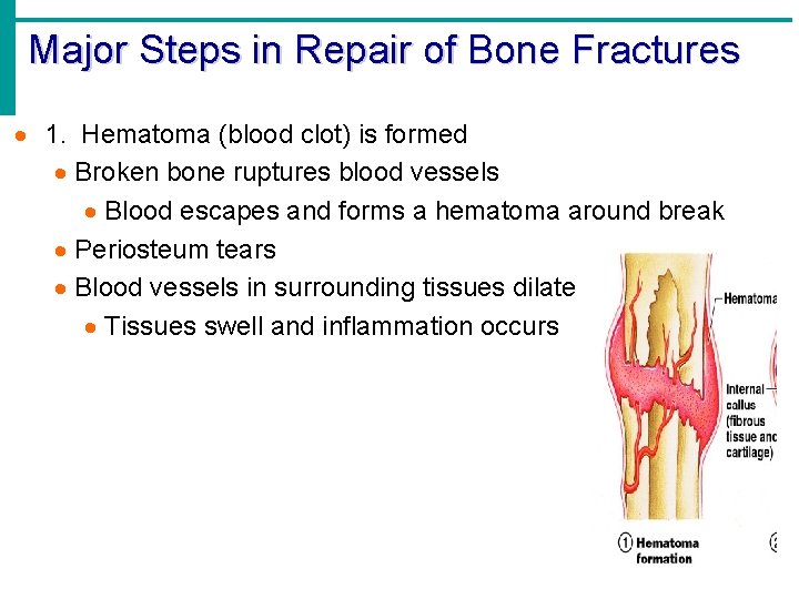 Major Steps in Repair of Bone Fractures · 1. Hematoma (blood clot) is formed Major Steps in Repair of Bone Fractures · 1. Hematoma (blood clot) is formed