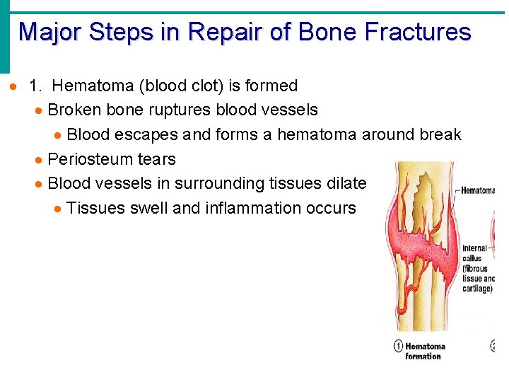 Major Steps in Repair of Bone Fractures · 1. Hematoma (blood clot) is formed