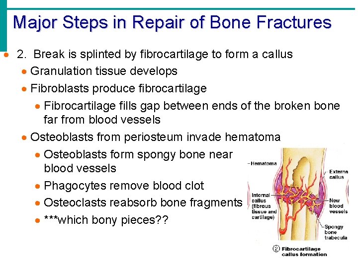 Major Steps in Repair of Bone Fractures · 2. Break is splinted by fibrocartilage Major Steps in Repair of Bone Fractures · 2. Break is splinted by fibrocartilage