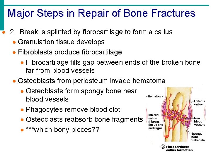 Major Steps in Repair of Bone Fractures · 2. Break is splinted by fibrocartilage