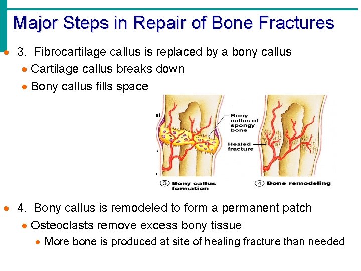Major Steps in Repair of Bone Fractures · 3. Fibrocartilage callus is replaced by