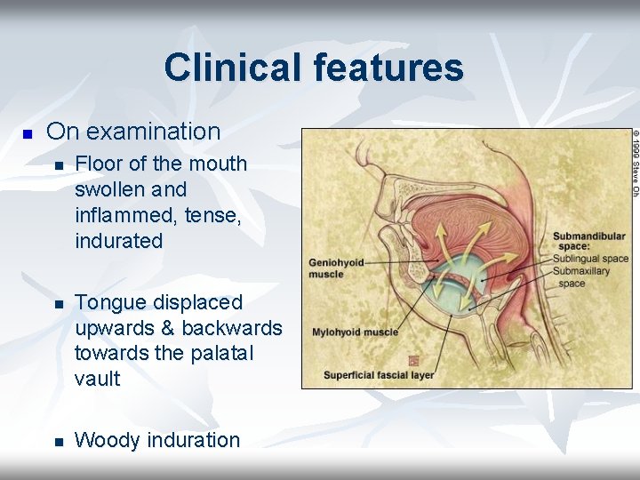 Clinical features n On examination n Floor of the mouth swollen and inflammed, tense,