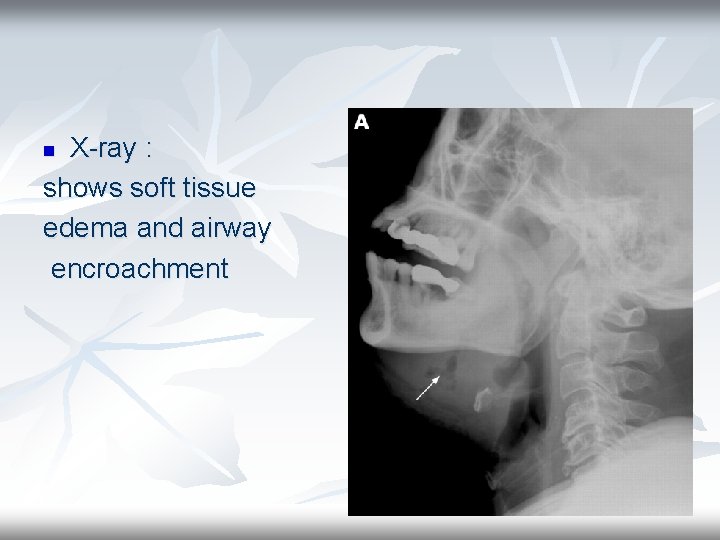 X-ray : shows soft tissue edema and airway encroachment n 