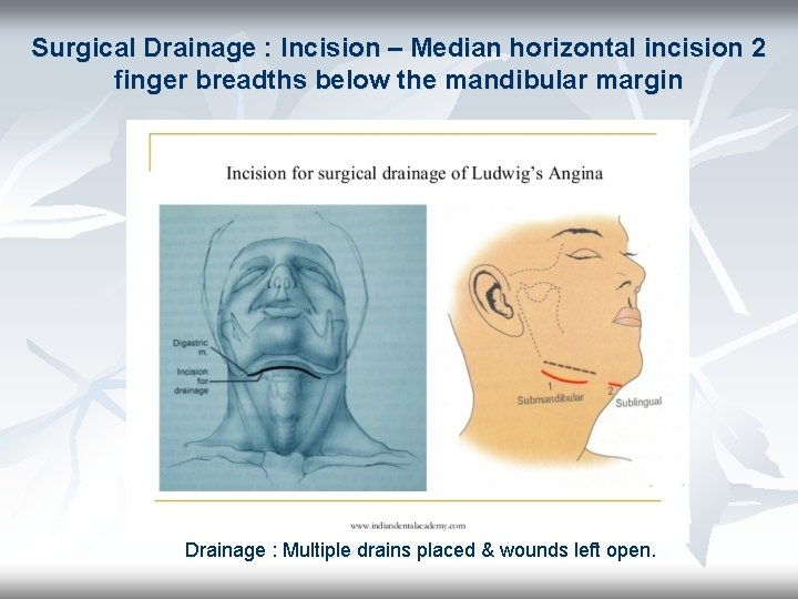 Surgical Drainage : Incision – Median horizontal incision 2 finger breadths below the mandibular