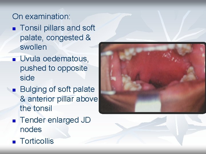 On examination: n Tonsil pillars and soft palate, congested & swollen n Uvula oedematous,