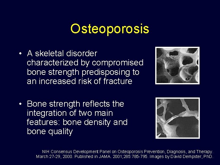 Osteoporosis • A skeletal disorder characterized by compromised bone strength predisposing to an increased