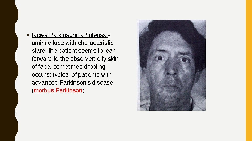 • facies Parkinsonica / oleosa amimic face with characteristic stare; the patient seems • facies Parkinsonica / oleosa amimic face with characteristic stare; the patient seems