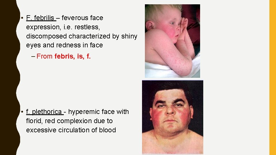 • F. febrilis – feverous face expression, i. e. restless, discomposed characterized by • F. febrilis – feverous face expression, i. e. restless, discomposed characterized by