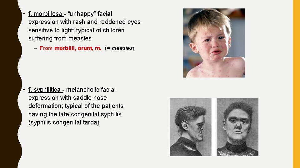  • f. morbillosa - “unhappy” facial expression with rash and reddened eyes sensitive