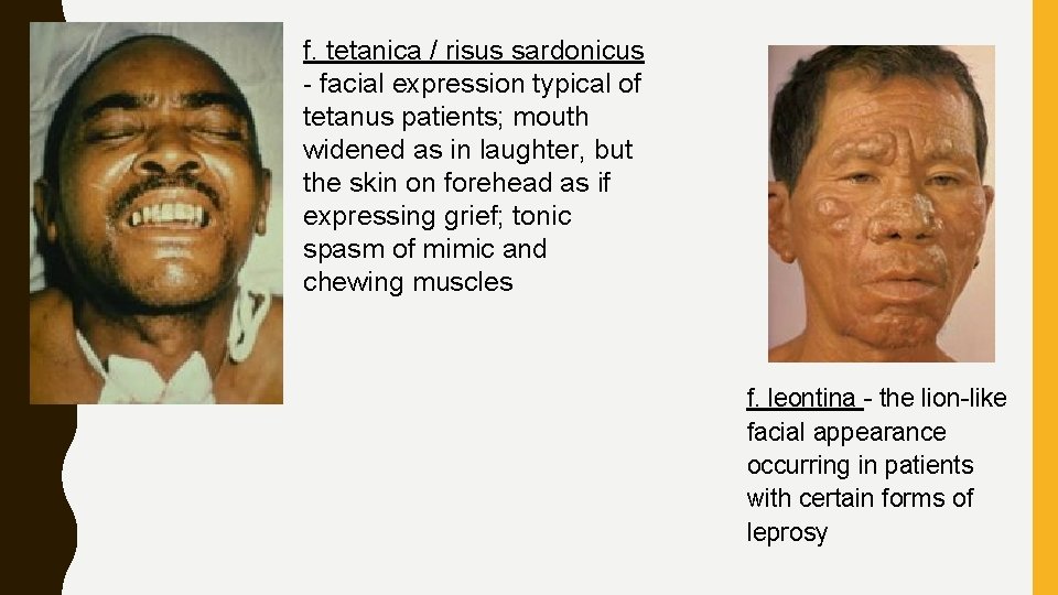 f. tetanica / risus sardonicus - facial expression typical of tetanus patients; mouth widened