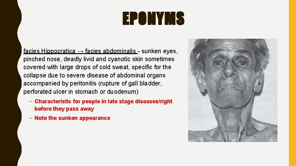 EPONYMS • facies Hippocratica → facies abdominalis - sunken eyes, pinched nose, deadly livid