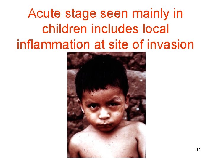 Acute stage seen mainly in children includes local inflammation at site of invasion 37