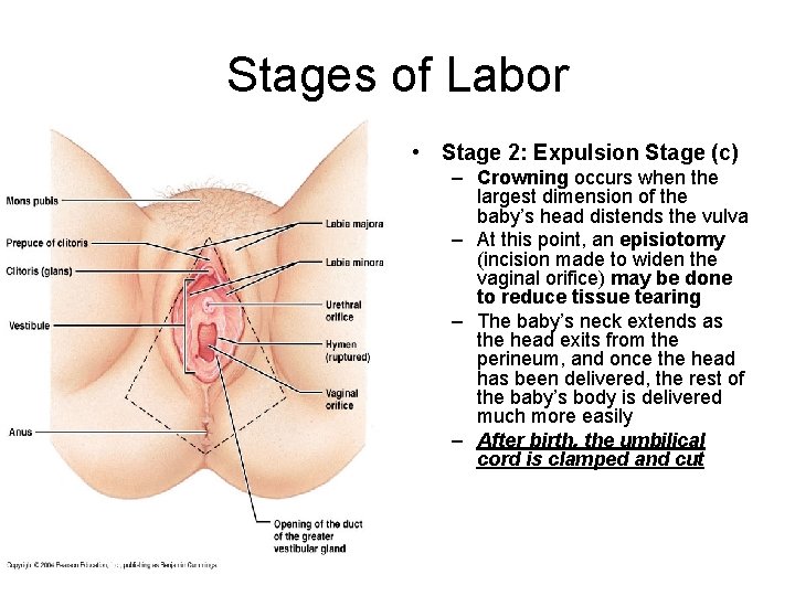 Stages of Labor • Stage 2: Expulsion Stage (c) – Crowning occurs when the