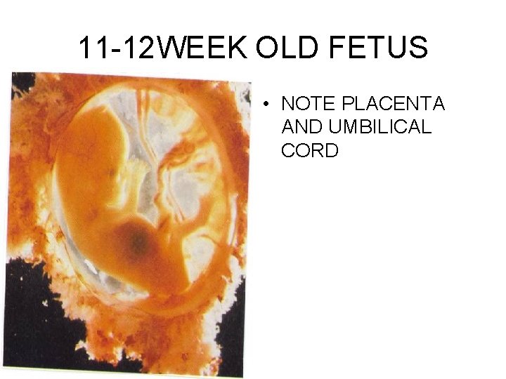 11 -12 WEEK OLD FETUS • NOTE PLACENTA AND UMBILICAL CORD 