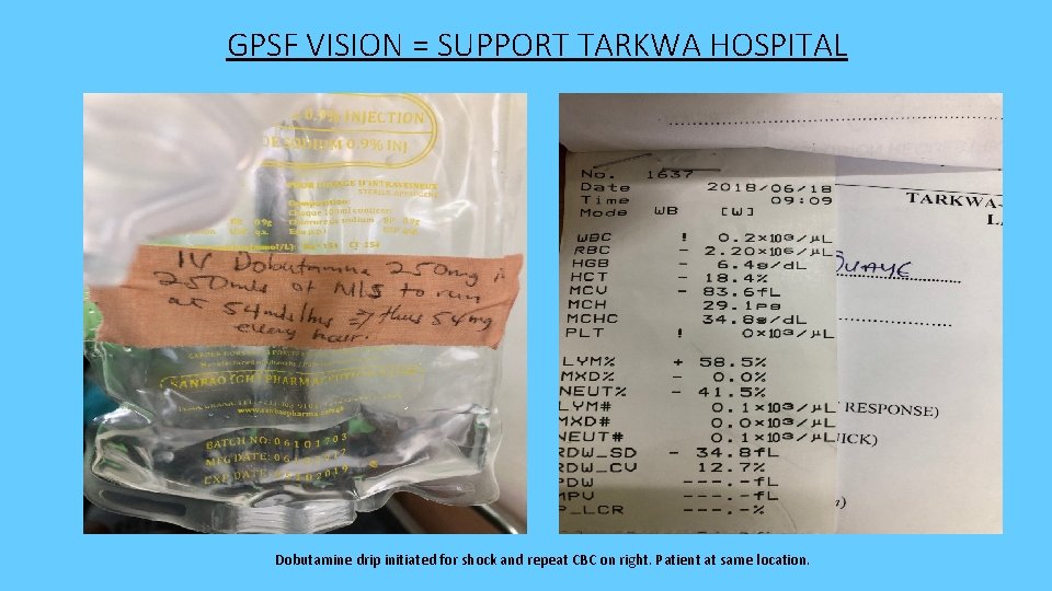 GPSF VISION = SUPPORT TARKWA HOSPITAL Dobutamine drip initiated for shock and repeat CBC