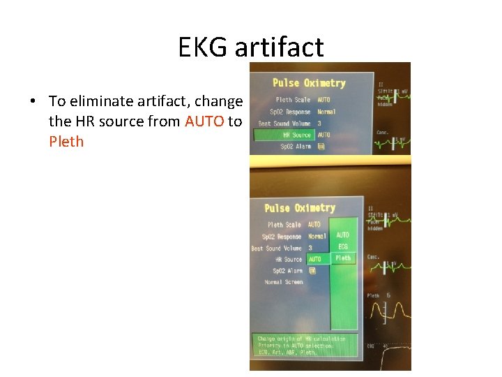 EKG artifact • To eliminate artifact, change the HR source from AUTO to Pleth