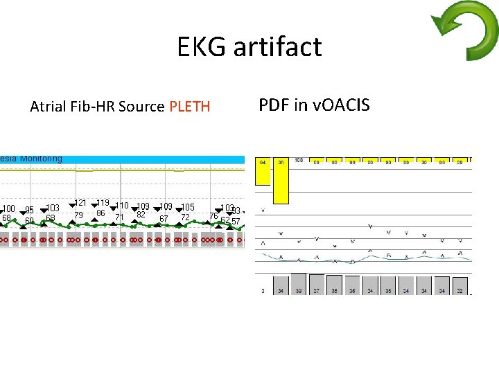 EKG artifact Atrial Fib-HR Source PLETH PDF in v. OACIS 